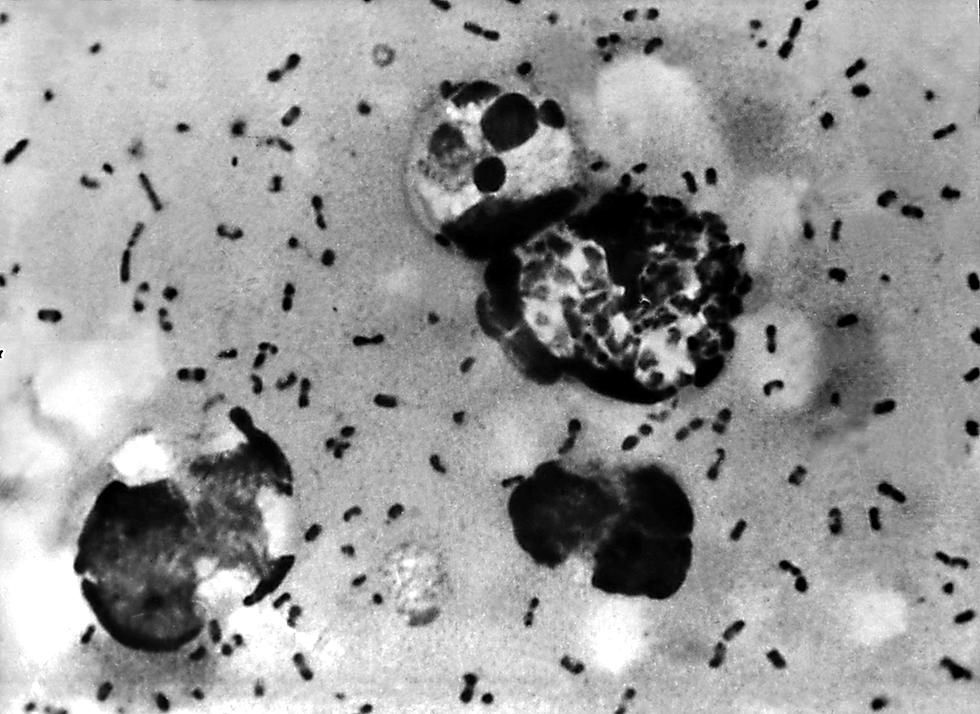 Wyoming Department of Health Reports Rare Human Case of Pneumonic Plague
