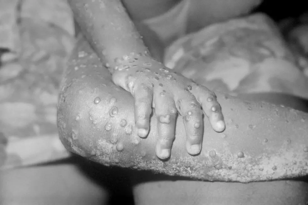 New Cases of Monkeypox Confirmed in Natrona County and Campbell County