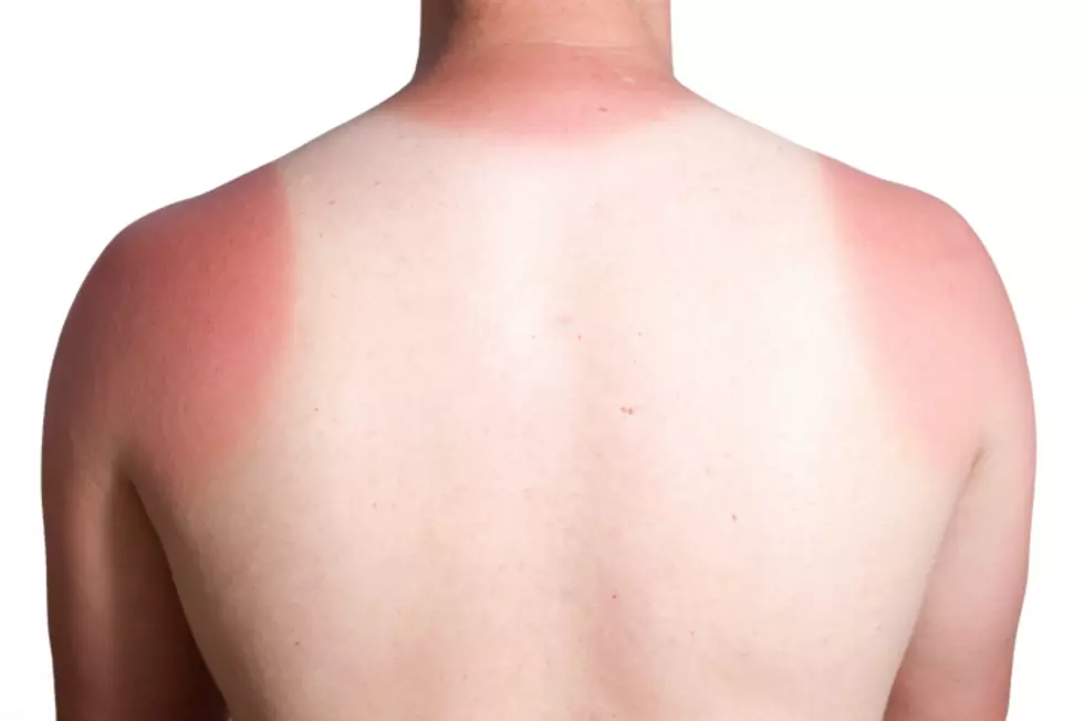 These Are The Best Remedies For a Really Bad Sunburn