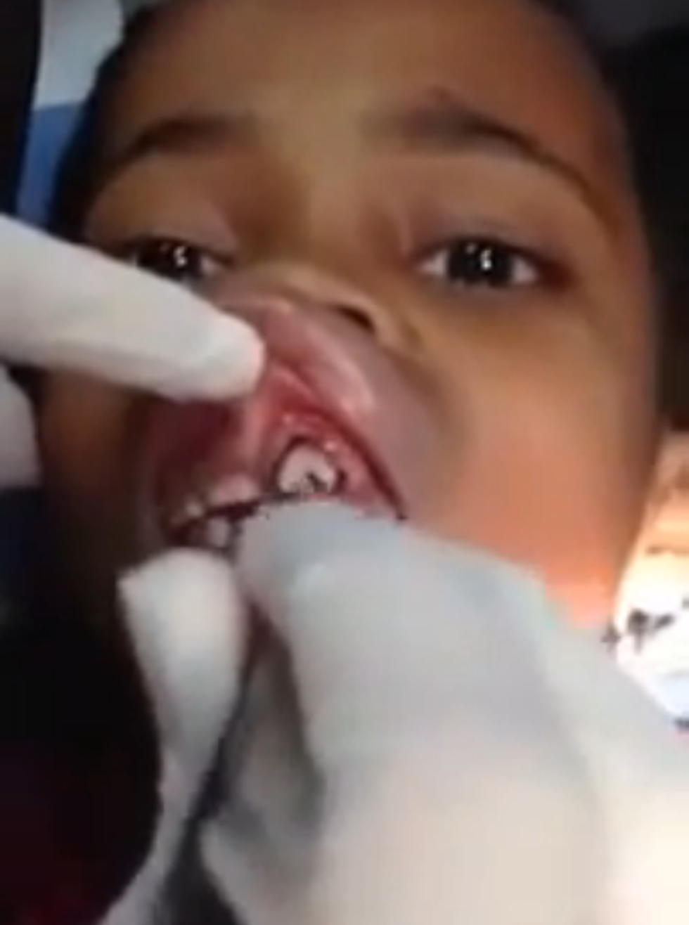 Dentist Removes Maggots from Girl’s Gums