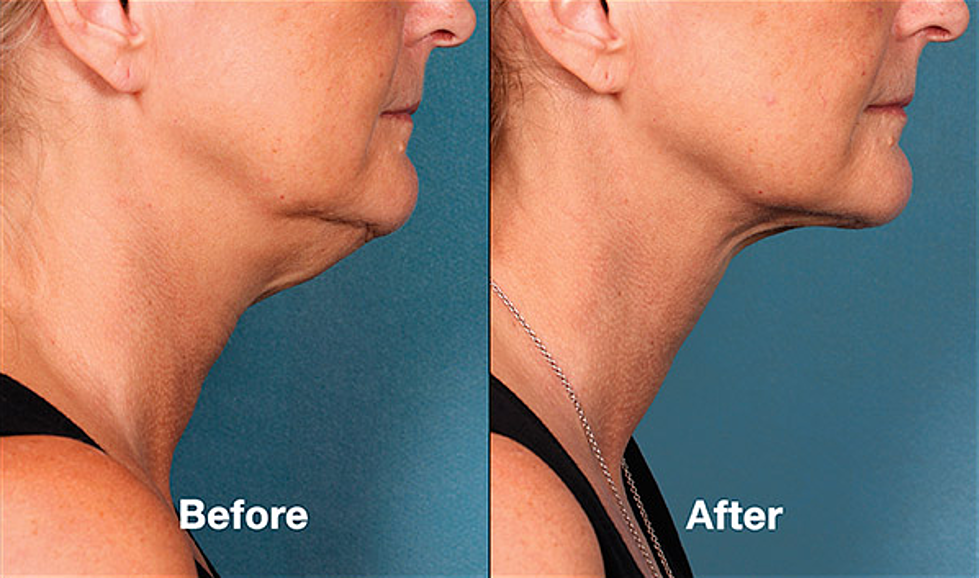 The Sanctuary by HealthCare Express Will Melt Away That Double Chin [SPONSORED]