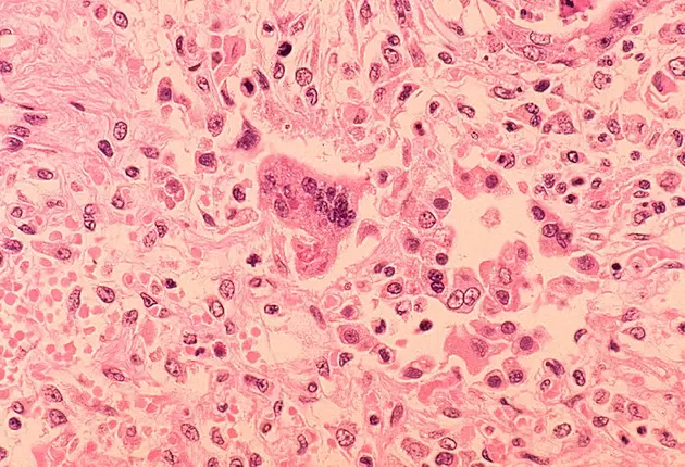 Minnesota Already has a Number of Confirmed Cases of Measles this Year