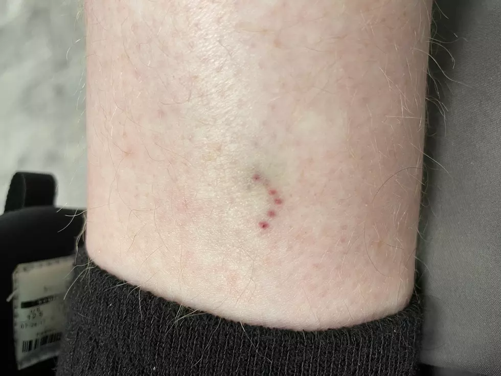 I Need Help Identifying The Bite Mark On My Leg