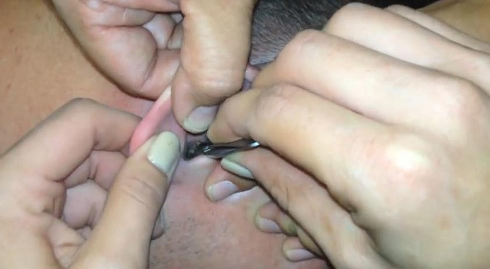 Guy Has Moth Stuck in His Ear, Gets it Removed in Gross Video
