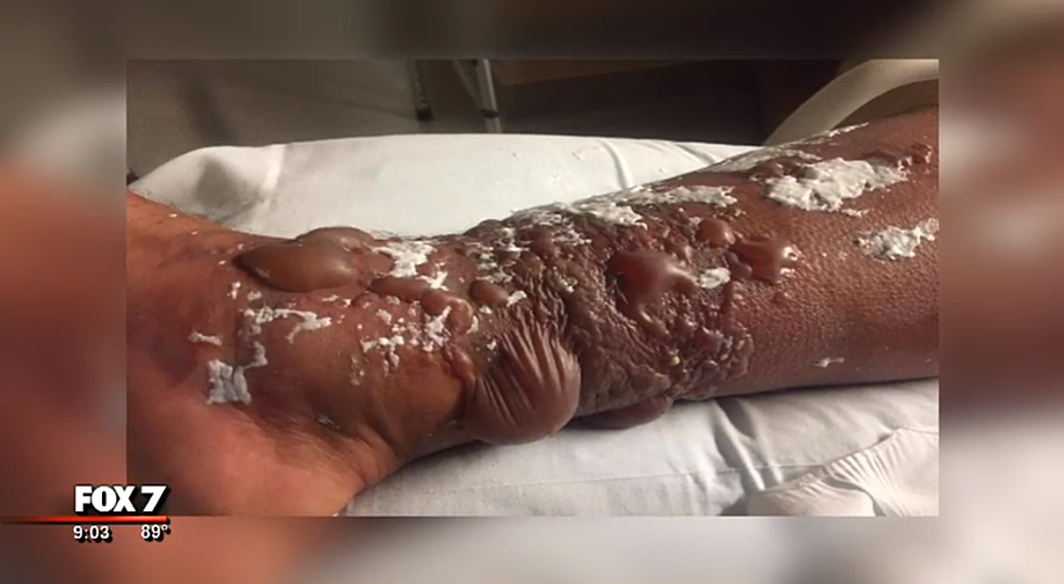 Another Texas Man May Lose Leg to Flesh-Eating Bacteria From Port Aransas [VIDEO]