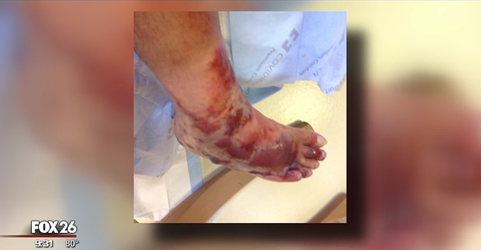 Texas Man Loses Leg to Flesh-Eating Bacteria in Galveston [VIDEO]