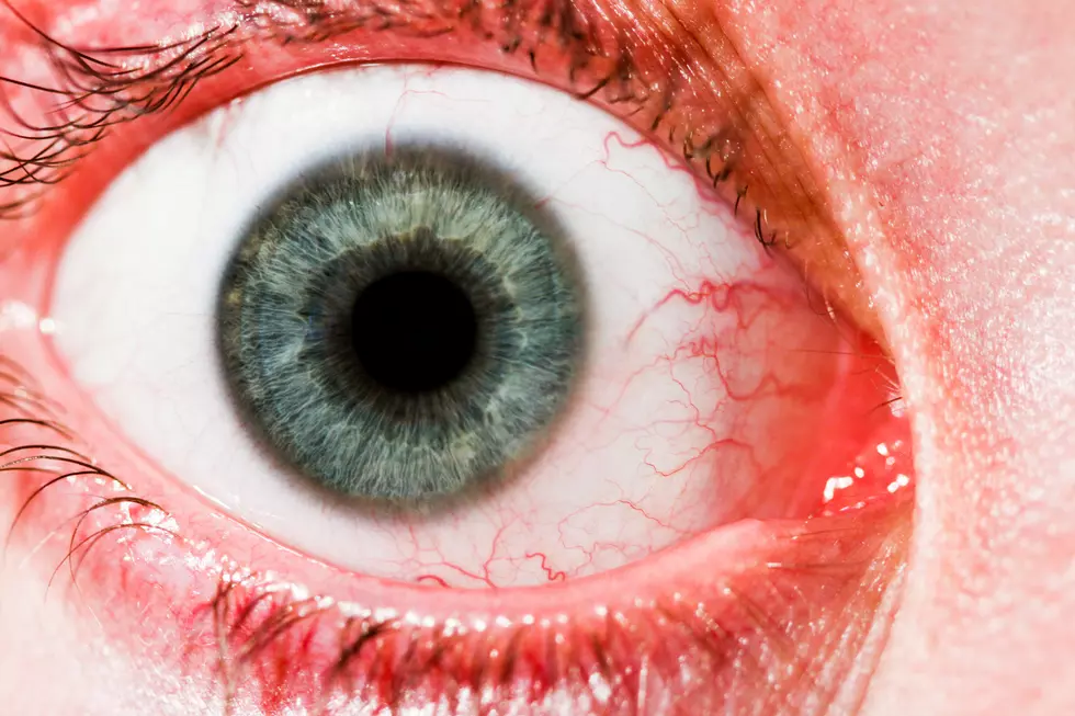 A Very Contagious Pink Eye ‘Superbug’ is Spreading Around Houston