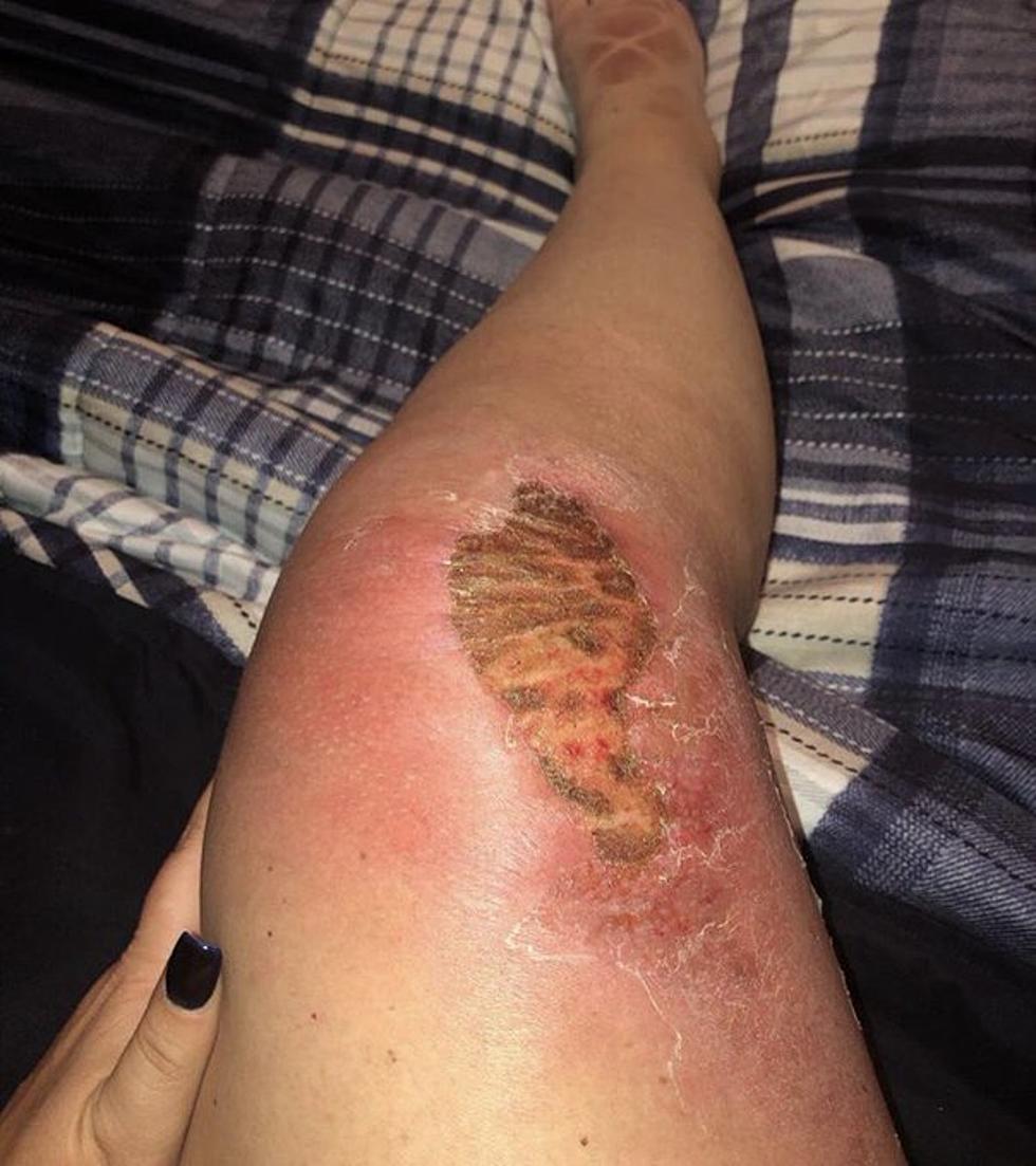 Texas Rangers Fans Share Photos of Severe Sunburns They Have Gotten at Globe Life Park
