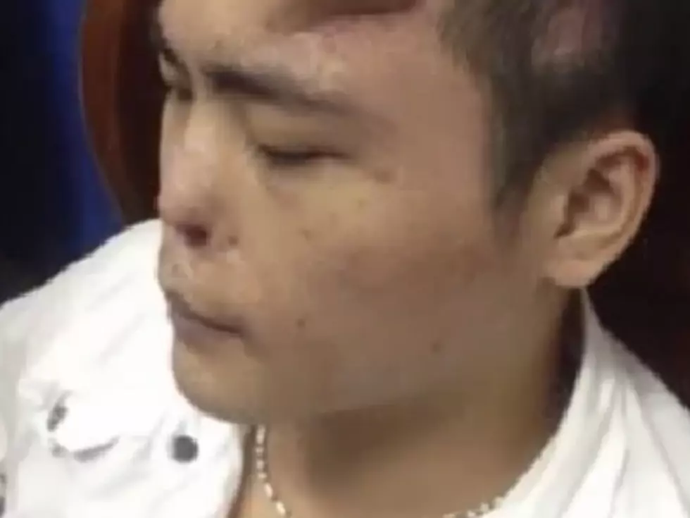 Doctor’s Grow ‘Replacement’ Nose on Accident Victim’s Forehead! Are You Brave Enough To Look?