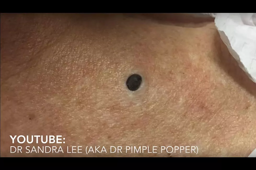The Reason Why You Are Obsessed With Pimple Popping Videos