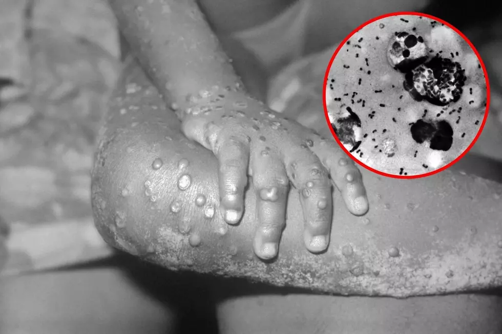 Should You Be Concerned? 20 Positive Cases of Monkeypox in Texas