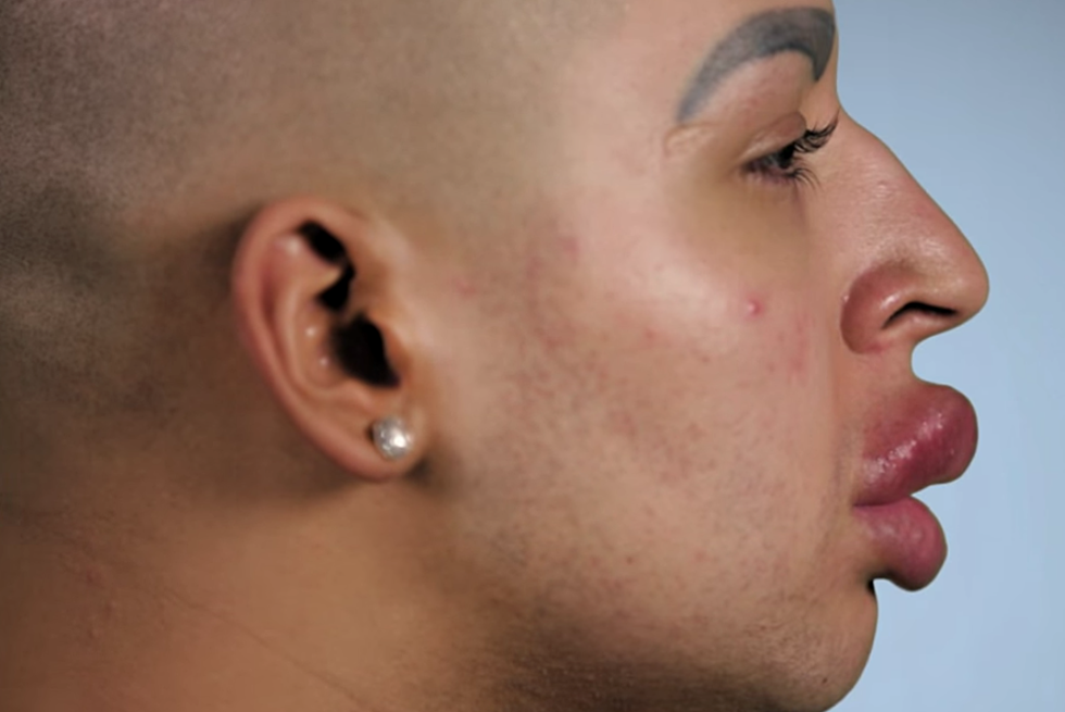 Remember The Guy Who Spent $150,000 To Look Like Kim Kardashian? Well, His Lips Are Leaking