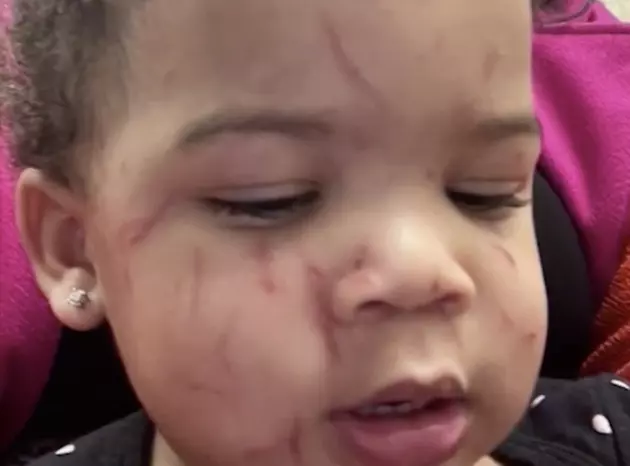 Mother in Louisiana Says Her Baby Was Attacked at Daycare [VIDEO]