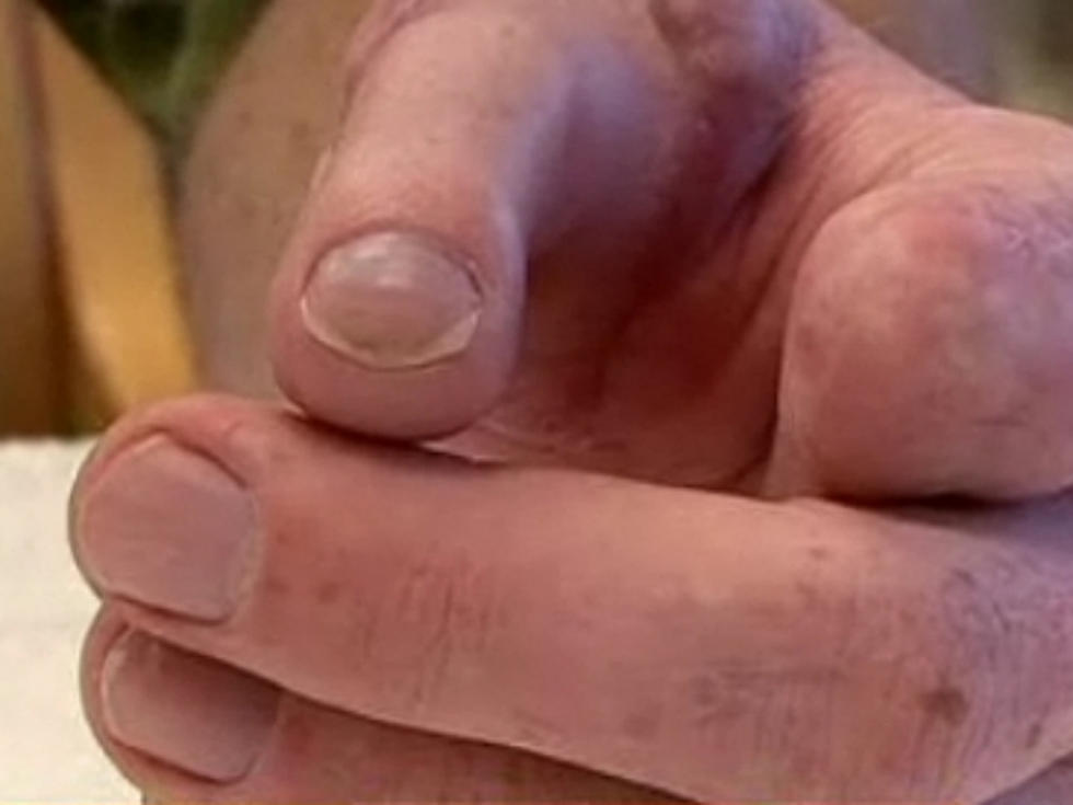 Man Receives Incredible Toe-to-Thumb Transplant [GRAPHIC VIDEO]