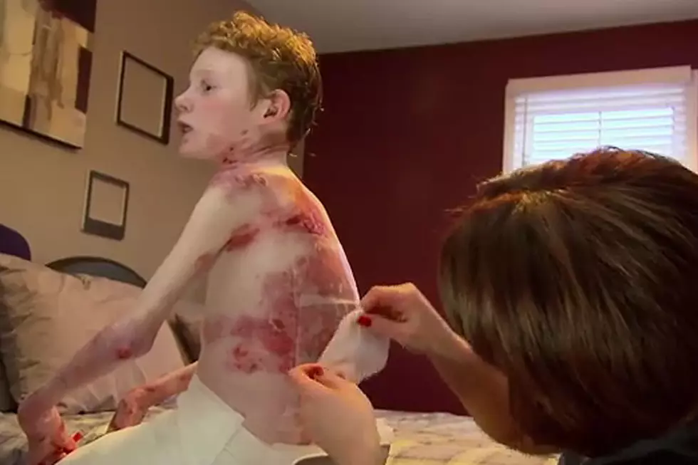 ‘Butterfly Boy’ Has Rare Disorder Causing Skin to Flake Off