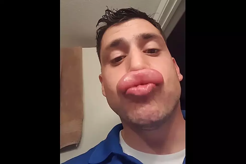 Guy Stung Twice on Lip By Wasps Has a Seriously Puffed-Up Pucker-Upper