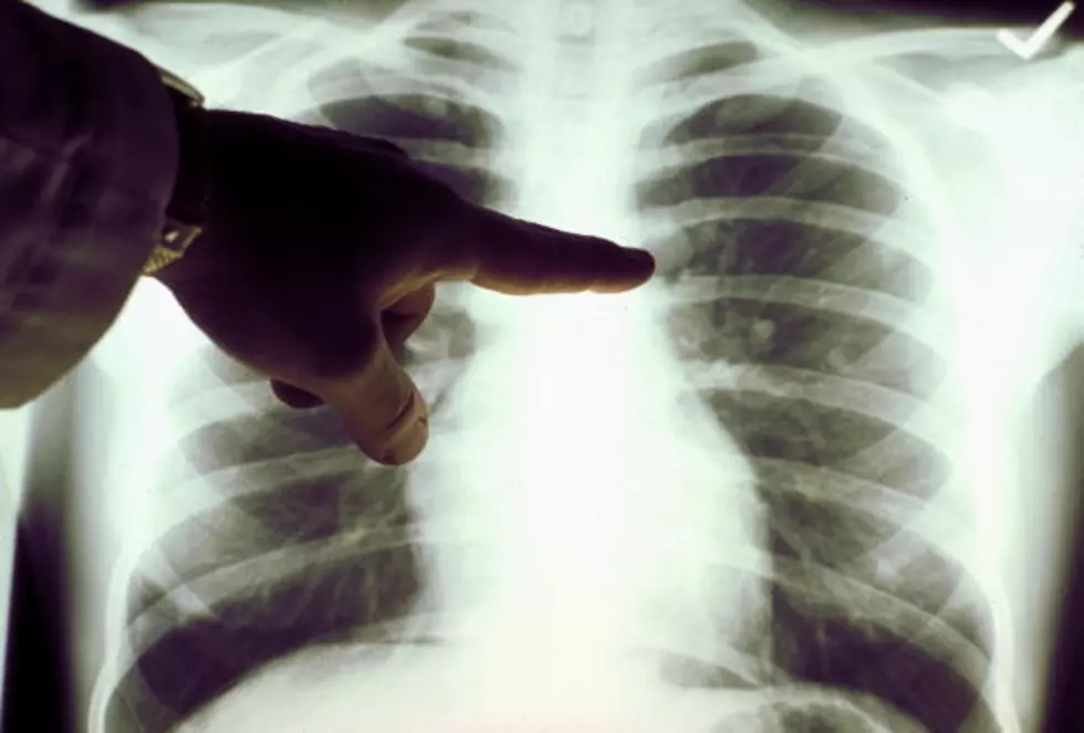 Cuba Has A Lung Cancer Vaccine & It’s Coming To The US