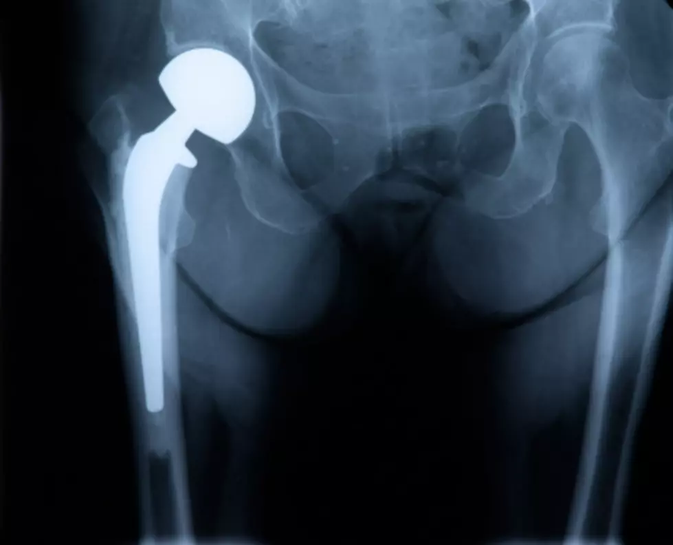 Hip Replacements More Likely to Fail in Women