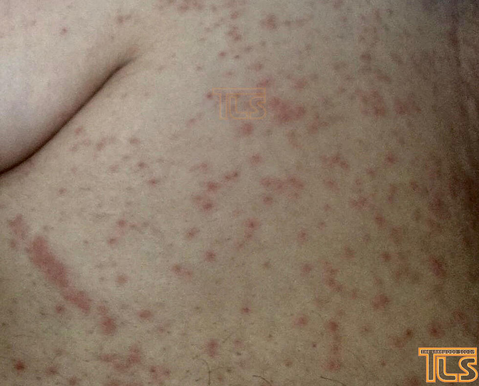 2 more Lakewood measles cases confirmed