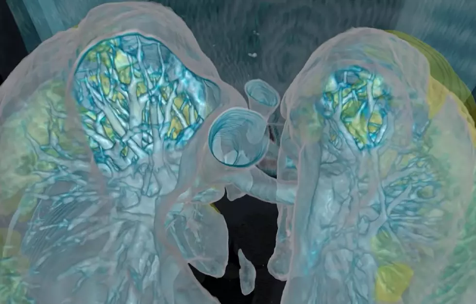 Go inside the lungs of a COVID-19 patient for virtual look at damage