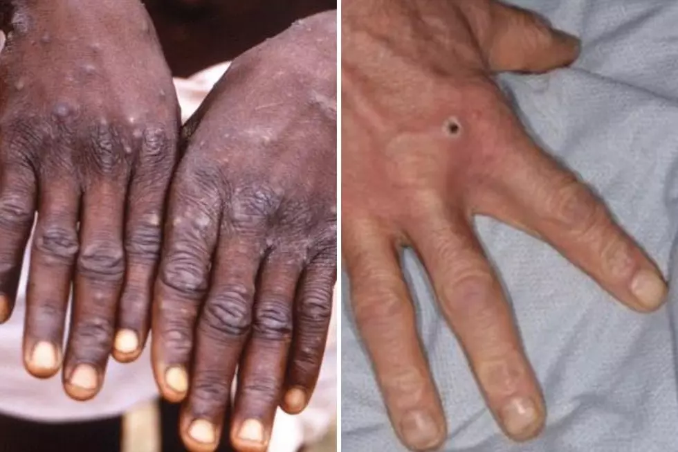 NJ records 8th monkeypox case, first confirmed in Camden County