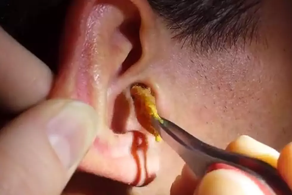 Wow, Wow, Wow, Does This Guy Have a Ton of Ear Wax. Wow.