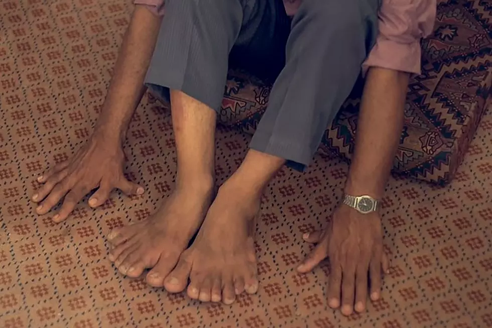 Record-Setting Man Has 28 Fingers and Toes