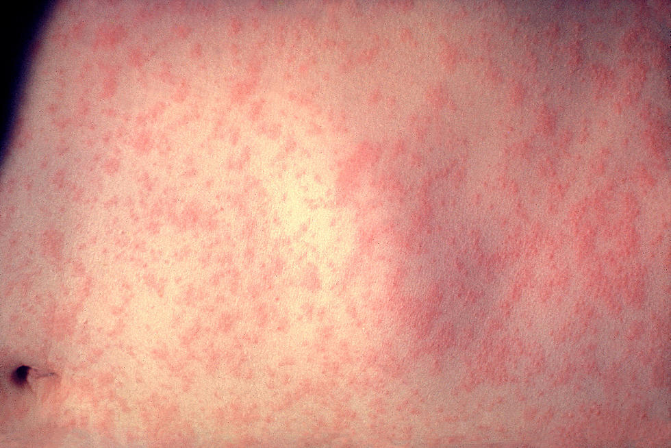 Health officials warn of potential North Jersey measles risk
