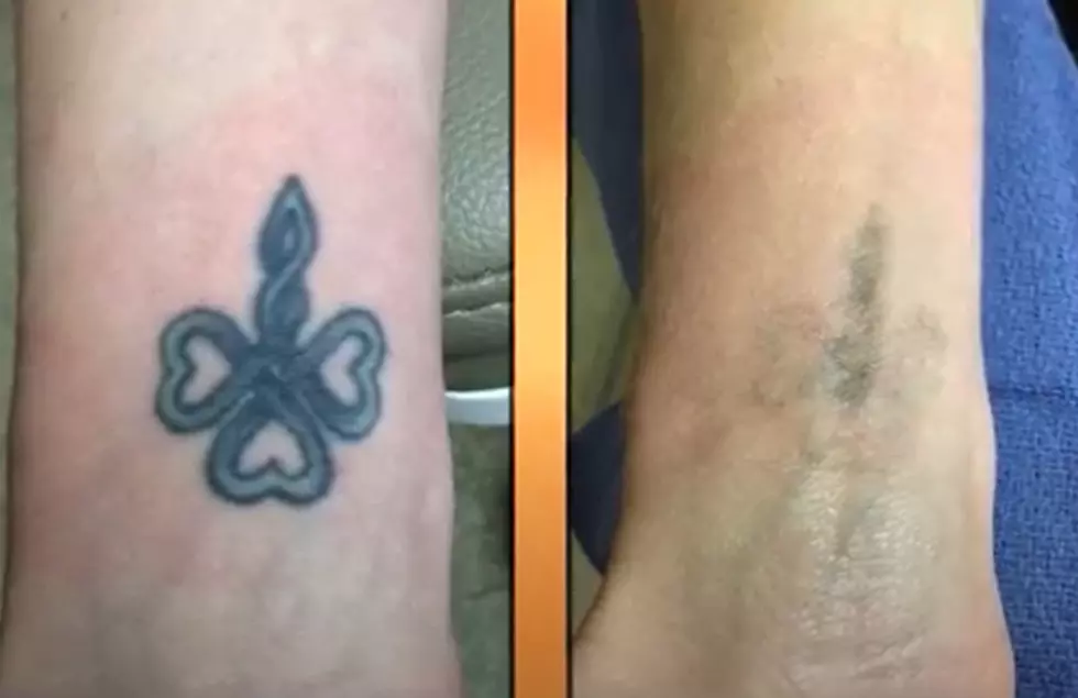 Tattoo Regret? This Laser Treatment Can Help