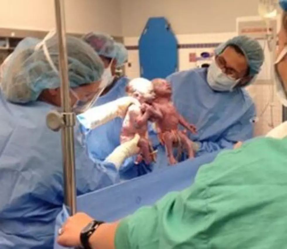 Identical Twins Born Holding Hands [VIDEO]