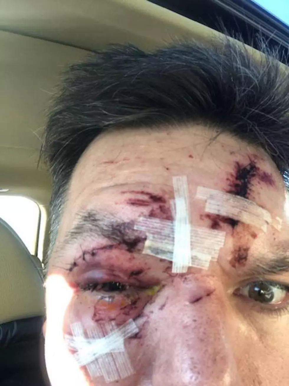 Man Shares Gruesome Injuries to Warn Others to Clear Ice Off Cars