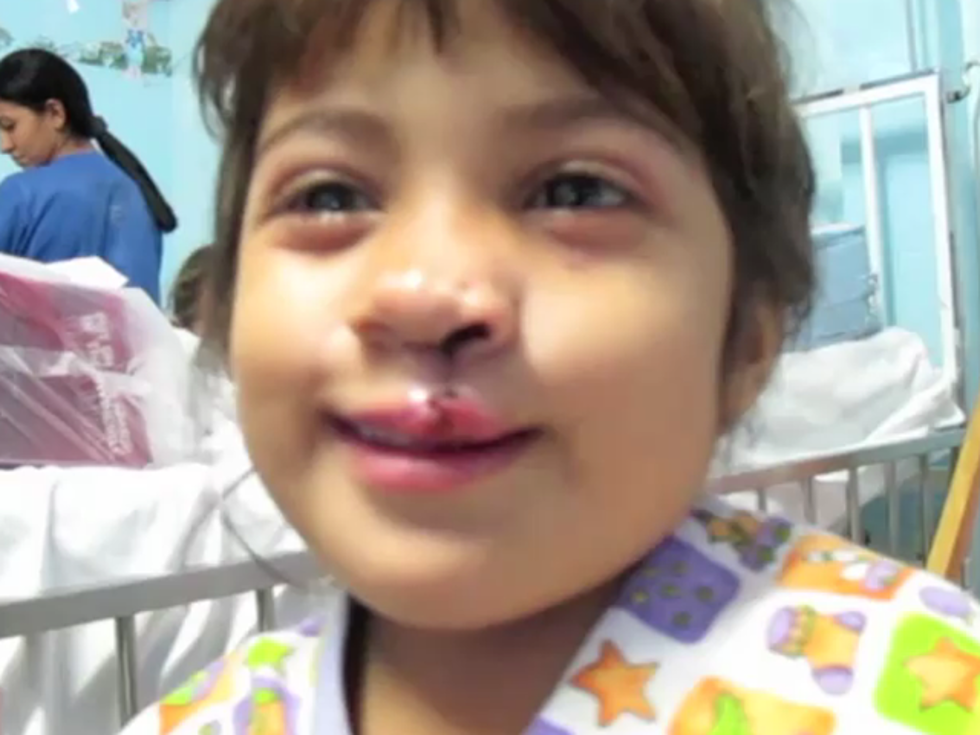 Little Girl’s Touching Reaction to Her New Face After Cleft Lip Surgery [VIDEO]