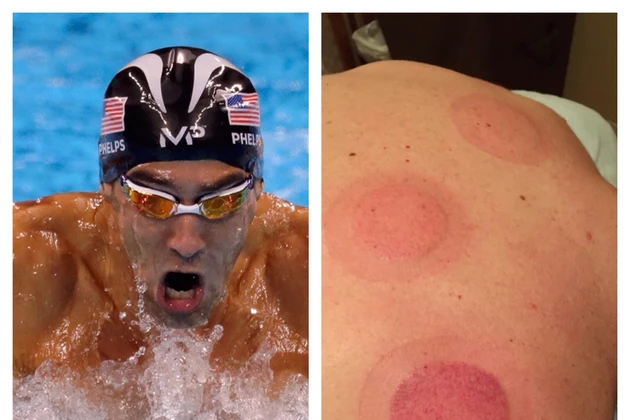 Todd&#8217;s Wife Jenny Shows How Cupping Helps Her and Michael Phelps