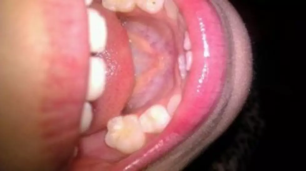 Have You Pulled Out a Loose Tooth with String? [Video]