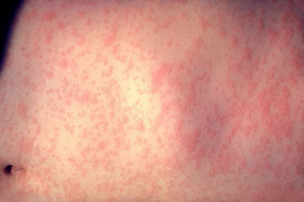CDC Reports First Confirmed Case Of Measles In Maine