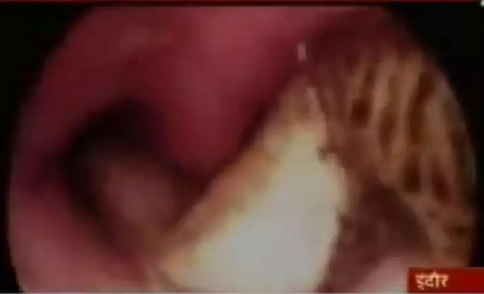 Doctors Remove Live Fish From Boy’s Lung – Daily Dose of Weird [VIDEO]
