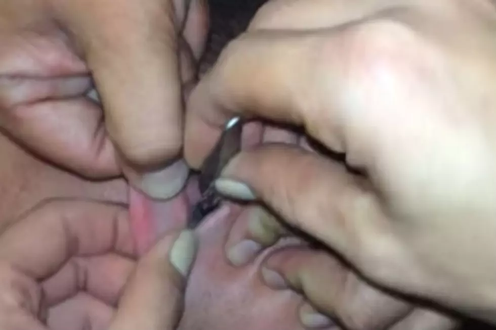 This Guy Had a Moth and a Tick Stuck in His Ear at the Same Time [NSFW VIDEO]