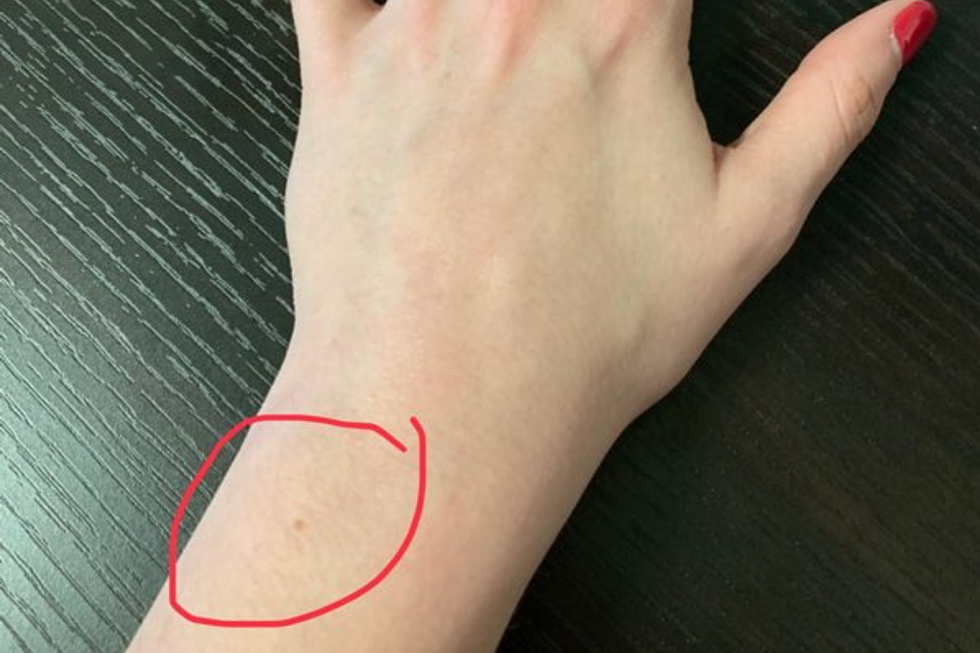 Why Do More Than Half the Women I Know Have Wrist Freckles?