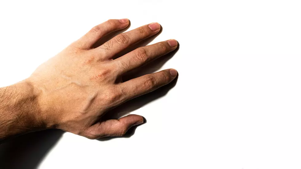Fact or Hoax: Does Cracking Your Knuckles Cause Arthritis?