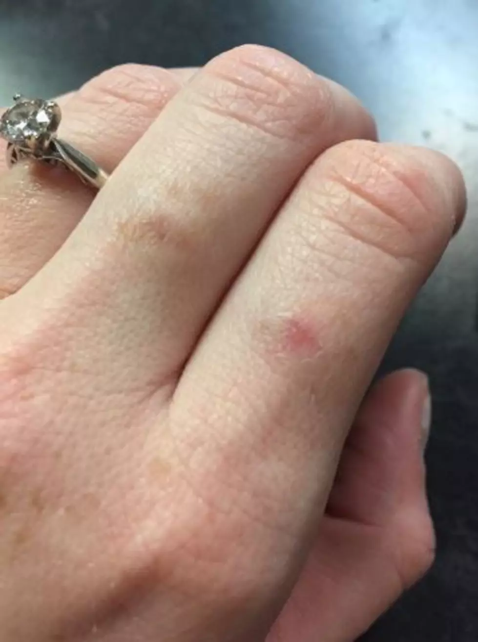 I Burned Myself Baking Yesterday&#8211;How Have You Hurt Yourself Cooking?