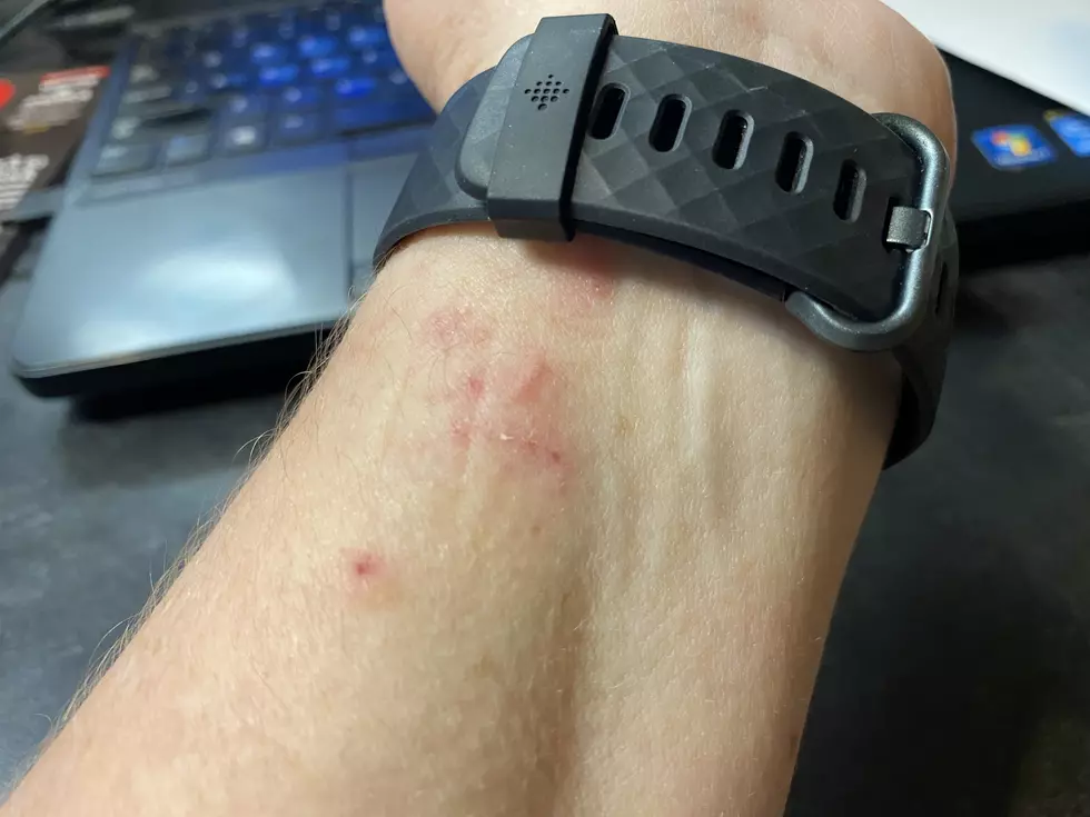 FitBit Rash is a Real Thing