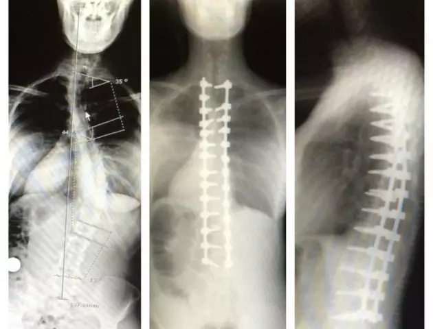 Carly&#8217;s Scary Spine!