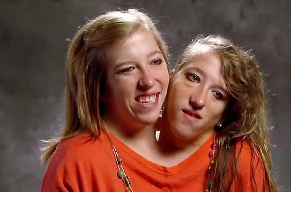 Minnesota Conjoined Twins – One of them Got Married in 2021