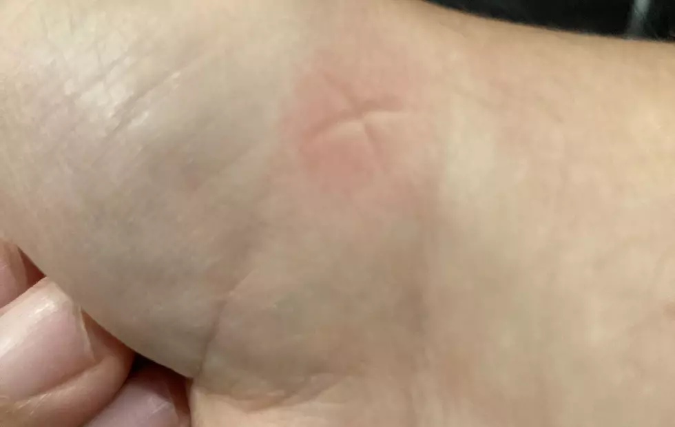 Do Any Other Minnesotans “Cure” Mosquito Bites Like This?