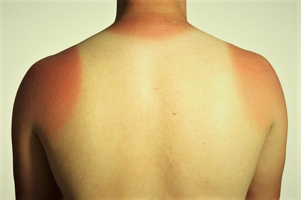 Maine Is One Of The Most Sunburned States, Pass The Aloe Vera