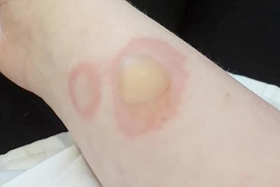 New Deodorant Challenge is Leaving Teens With Second-Degree Burns