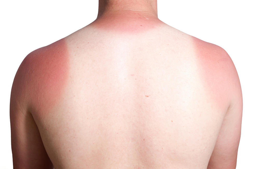 This Product in Your Cupboard Could be the Quickest Relief for a Sunburn