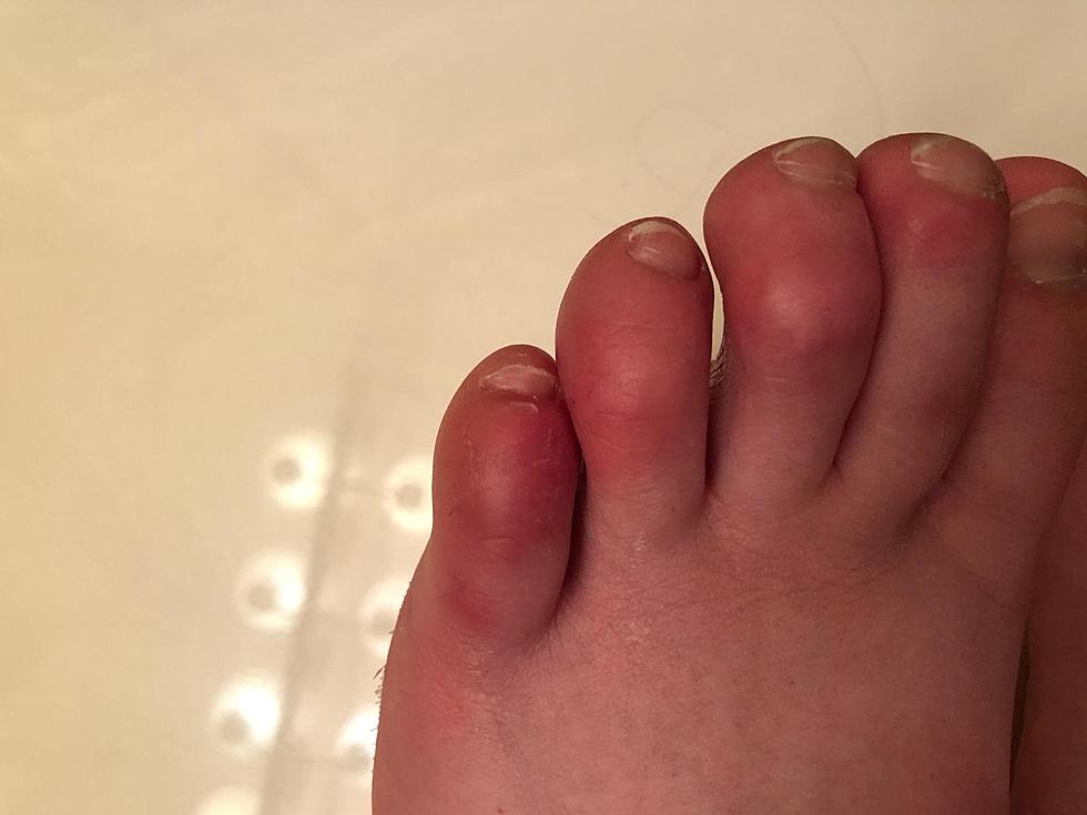 “COVID Toes” Could Be First Sign of COVID-19 Infection