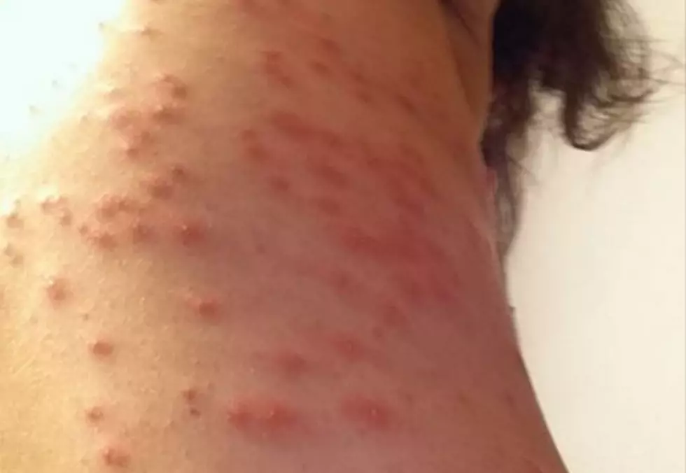 Woman Claims She Got Bed Bug Bites During Wisconsin Dells Resort Stay