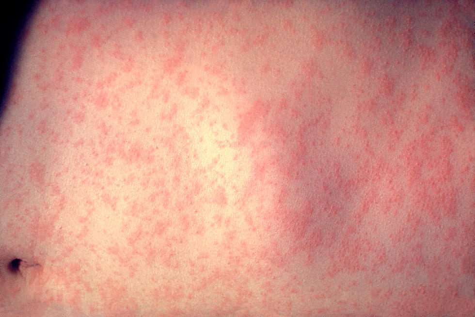 MEASLES PRESENTS A REVACCINATION ISSUE